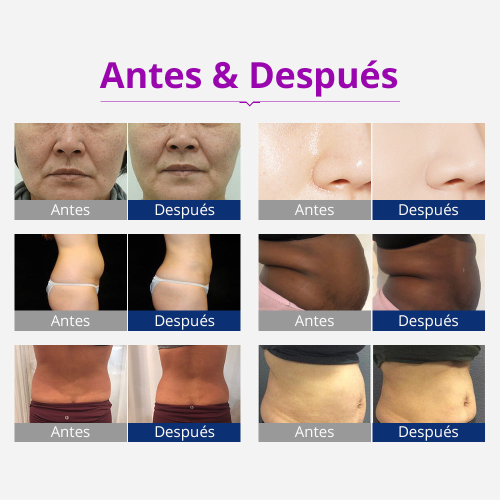 Multifunconal 6 en 1 de Cavitación Ultrasónica 40K, Radiofrecuencia, Vacum y Lipolaser de Alta Precisión