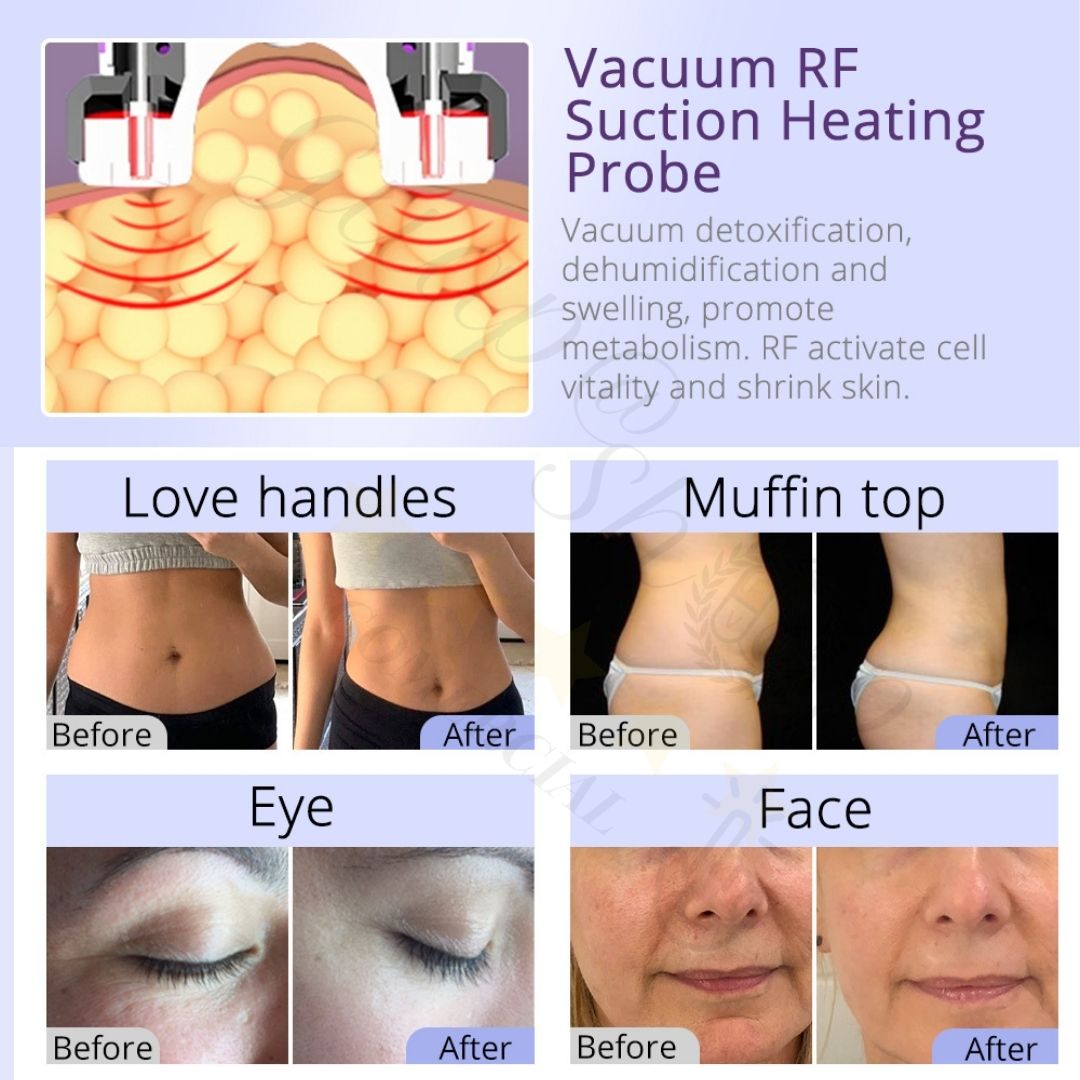 Equipo Multifuncional De Radiofrecuencia 10 En 1 Con Cavitación 2.5 Ultrasónica Avanzada, Lipo Láser, Bio Fotón, Ultrasonido, Microcorriente, Depurador Facial