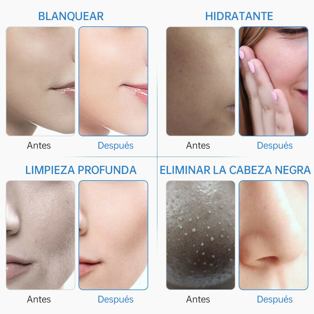 Máquina Hidrofacial 6 en 1  Limpieza Profunda, Microdermoabrasión, Radiofrecuencia, Ultrasonido, Pulverizador, Terapia Fría – Profesional para Spa y Estética